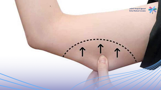 عملية-شفط-دهون-الذراعين