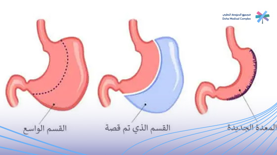 عملية-التكميم