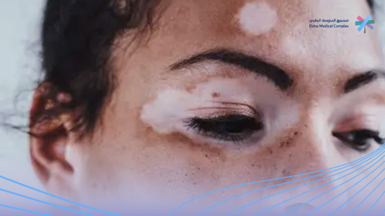 أنواع-البهاق