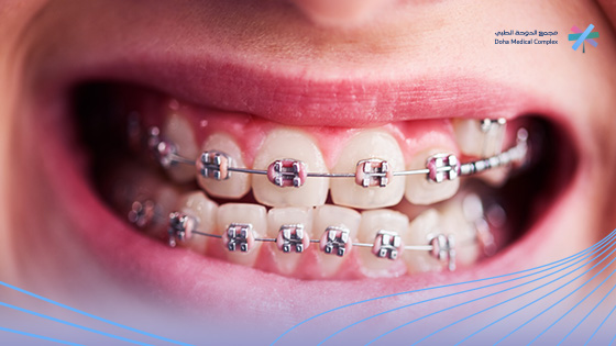 أنواع-تقويم-الأسنان-بالصور-واسعارها 