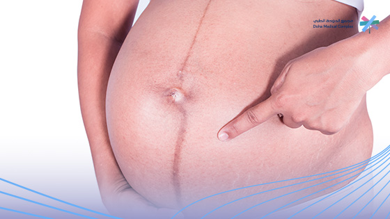 خط-البطن-للحامل 