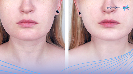 فوائد-حقن-البلازما-للوجه