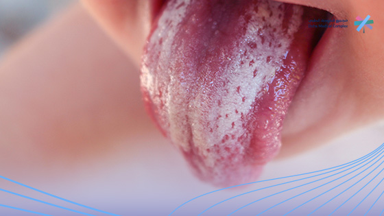 شكل-فطريات-الفم-عند-الرضع