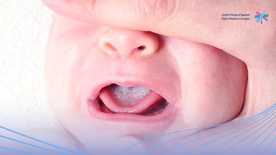 شكل-فطريات-الفم-عند-الرضع