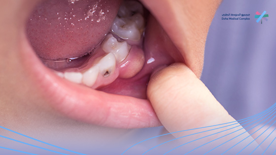 تعفن-مكان-خلع-الضرس