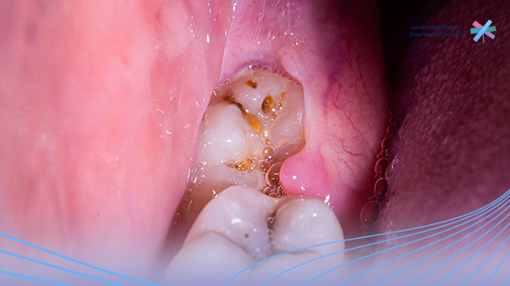 تعفن-مكان-خلع-الضرس