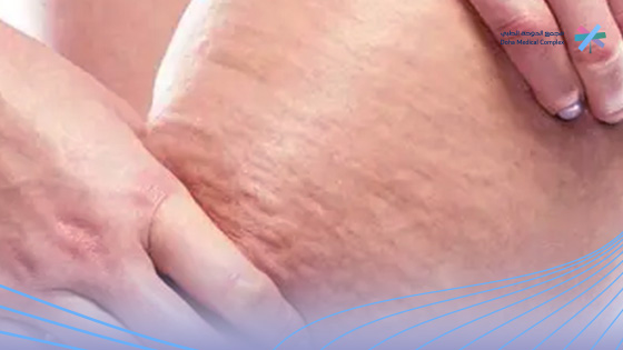 اسباب-ظهور-السيلوليت