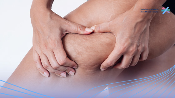 اسباب-ظهور-السيلوليت