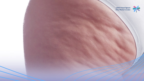 اسباب-ظهور-السيلوليت