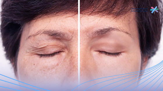 الشد-المائي-قبل-وبعد