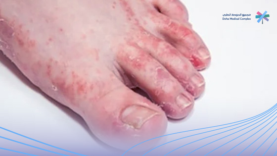 اسباب-فطريات-القدم