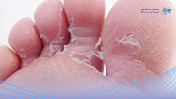 شكل-فطريات-القدم-بسرعة