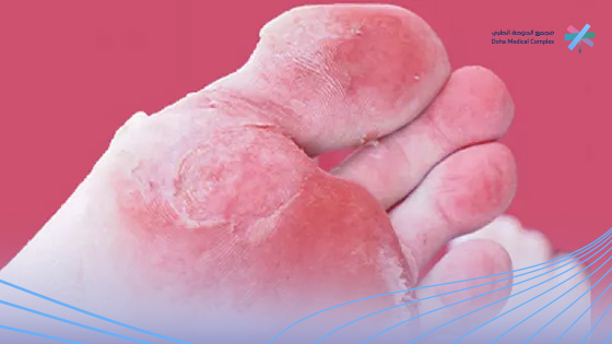 علاج-فطريات-القدم