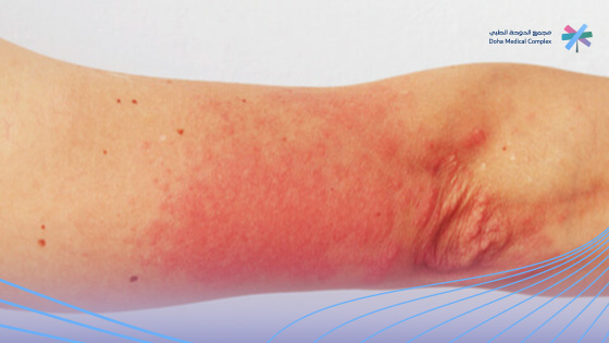 أعراض-الإيدز-عند-النساء