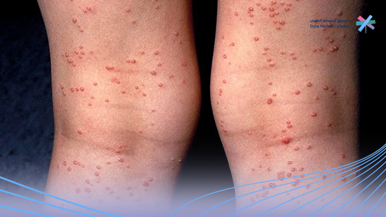 أعراض-الإيدز-عند-النساء