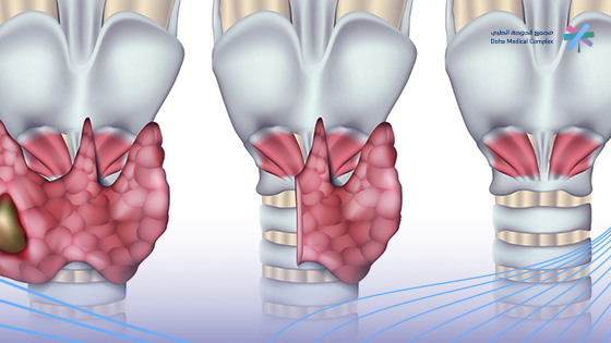 هل-يزيد-الوزن-بعد-استئصال-الغدة-الدرقية