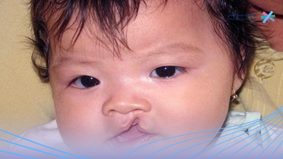 تكلفة-عملية-الشفة-الأرنبية-في-السعودية