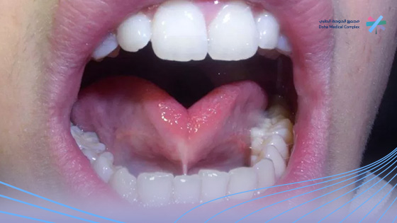 عملية-اللسان-المربوط-بالليزر