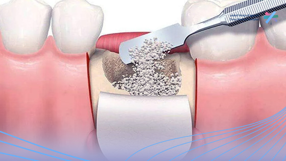 كم-تستغرق-عملية-زراعة-عظم-الفك؟