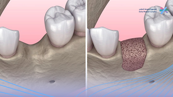 نسبة-نجاح-زراعة-عظم-الفك