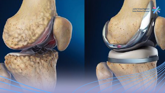 نصائح-بعد-عملية-تغيير-مفصل-الركبة