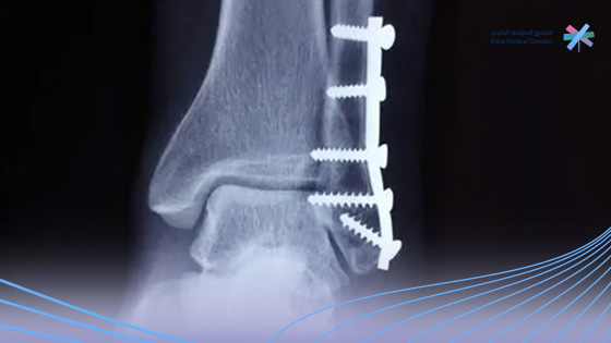 التوقيت-المناسب-لإزالة-الشرائح-والمسامير
