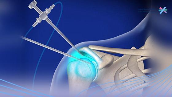 تكلفة-عملية-قطع-وتر-الكتف-بالمنظار