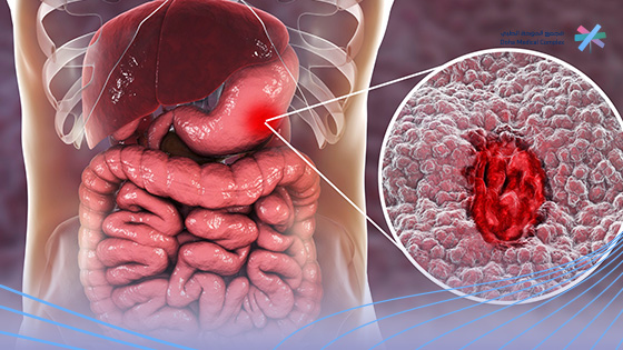 علاج-قرحة-المعدة-بالعسل-وقشر-الرمان