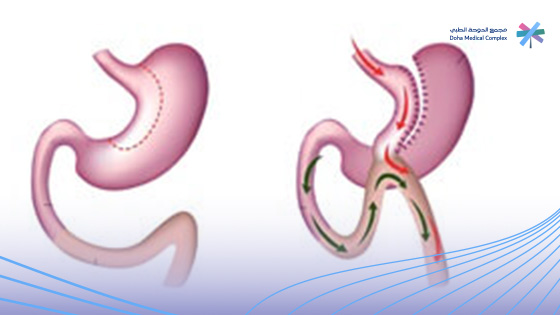 تجربتي-مع-تحويل-المسار-بعد-التكميم