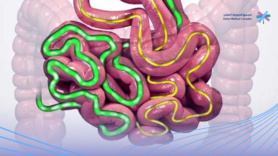 تجربتي-مع-تحويل-المسار-بعد-التكميم