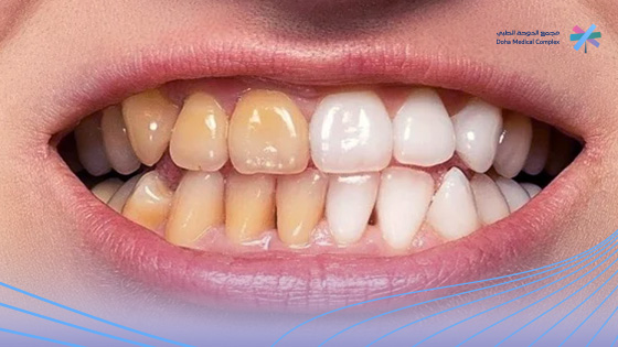 تبييض-الاسنان-بالزوم-قبل-و-بعد