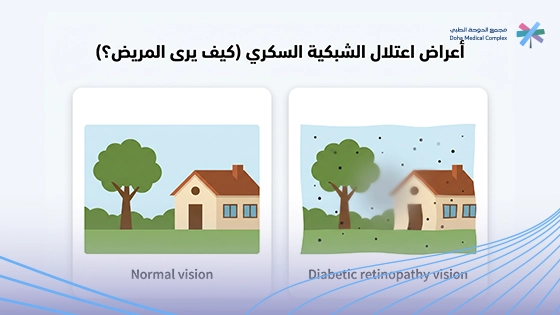صورة-توضح-أعراض-اعتلال-الشبكية-السكري