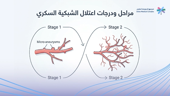 صورة-توضح-درجات-اعتلال-الشبكية-السكري-ومراحله: