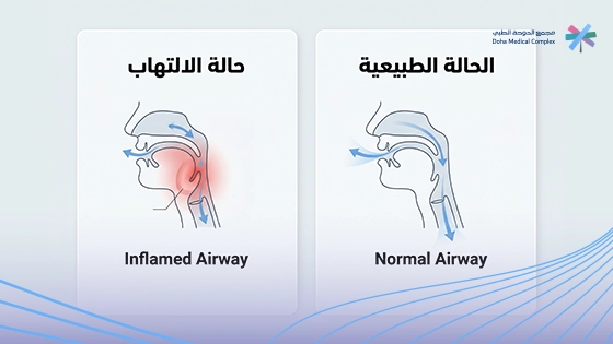 صورة-توضح-ما-هو-التهاب-لسان-المزمار
