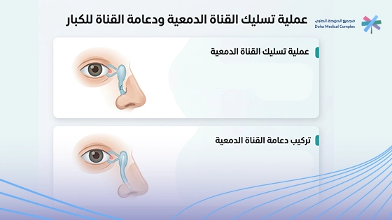 صورة-توضح-عملية-تسليك-القناة-الدمعية-للكبار