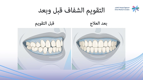 صورة-توضح-نتائج-التقويم-الشفاف-قبل-وبعد