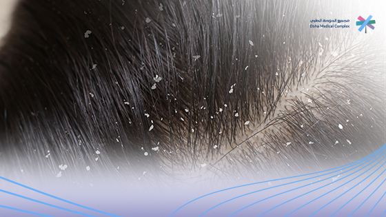 اسباب القشرة وتساقط الشعر: دراسة شاملة للحلول والوقاية