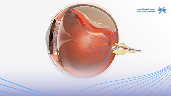 علاج-انفصال-شبكية-العين