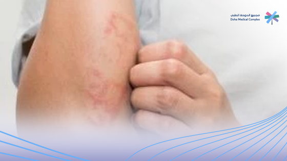 علاج الاكزيما بالاعشاب الطبيعية