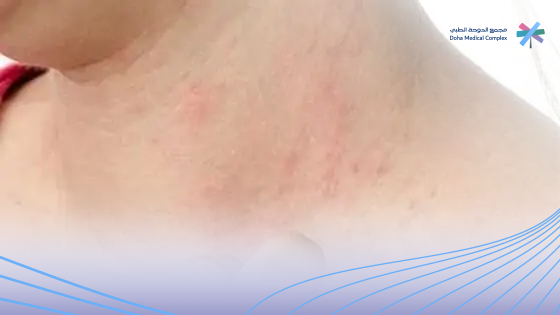 أسباب وأنواع فطريات الجلد وعلاجها