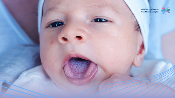 علاج فطريات اللسان عند الرضع