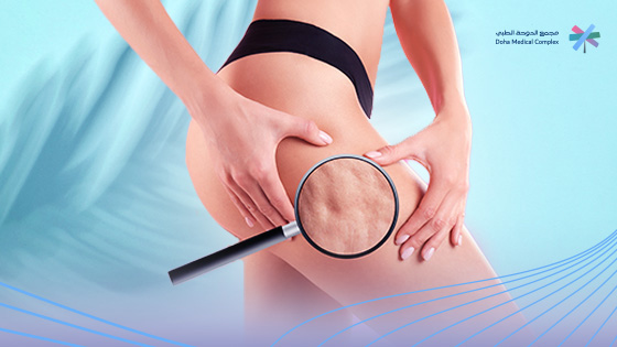 اسباب-ظهور- السيلوليت