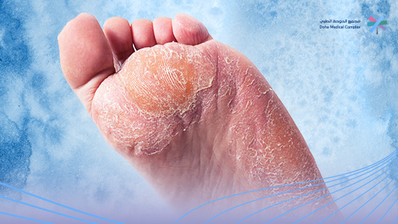 أنواع-فطريات-القدم