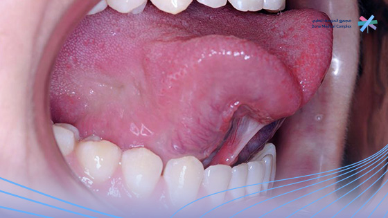 عملية-اللسان-المربوط-بالليزر