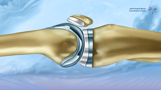 سعر-عملية-تغيير-مفصل-الركبة-في-السعودية