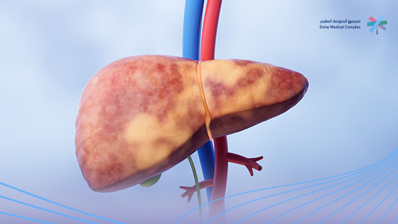 الأكل-الممنوع-لمرضى-الكبد-الدهني