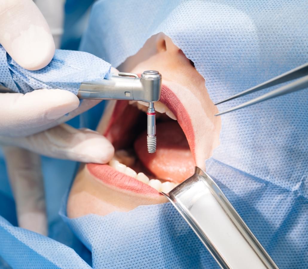جراحة وزراعة الأسنان